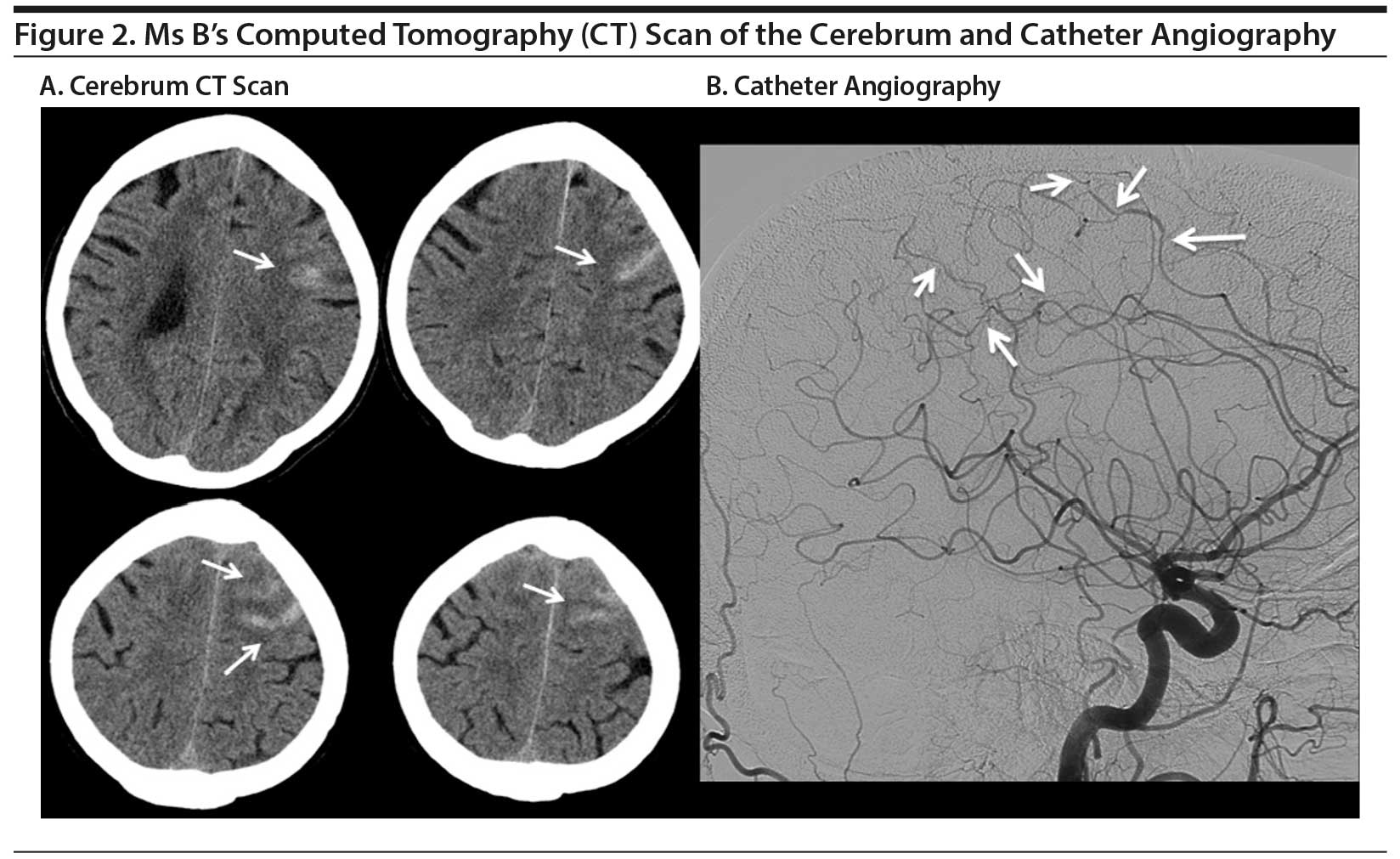 Reversible Cerebral Vasoconstriction Syndrome