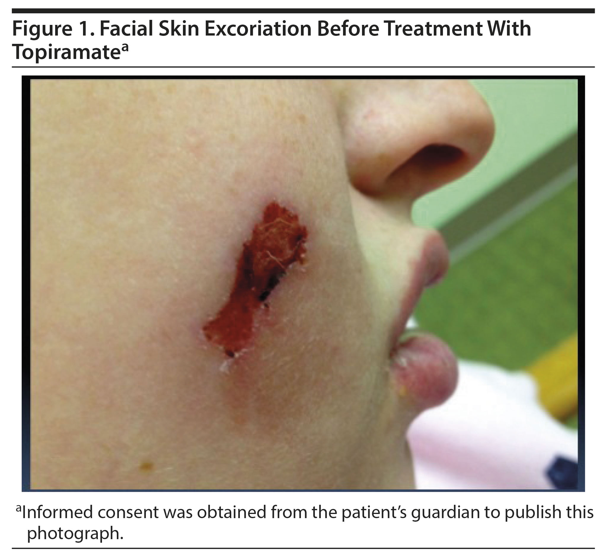 excoriation disorder