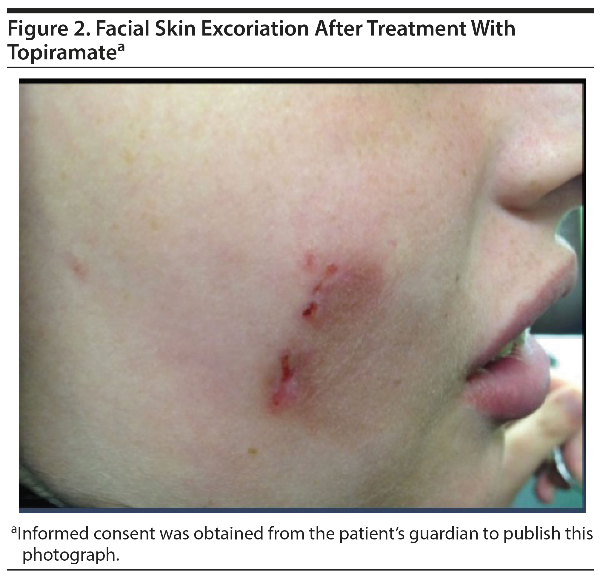 excoriation disorder