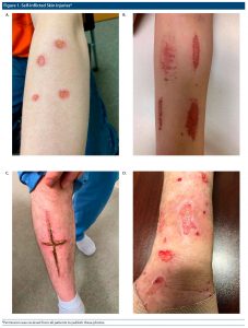 A Brief Review of Dermatitis Artefacta and Management Strategies for ...