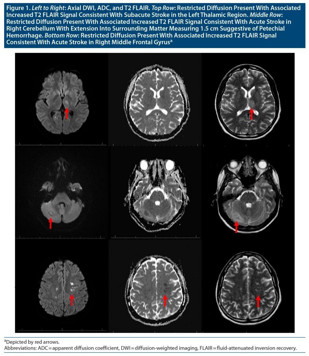 Multiple Strokes in a Patient With Systemic Lupus Erythematosus in the ...