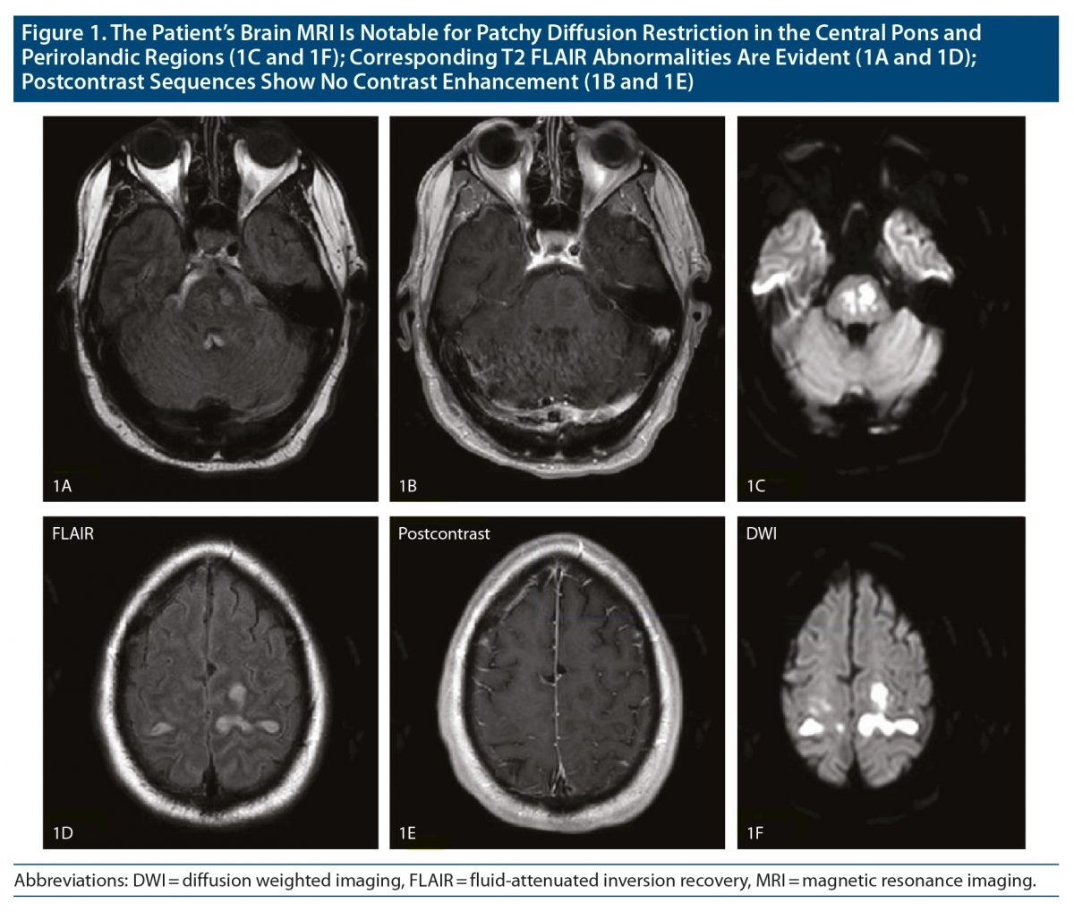 Central and Extrapontine Myelinolysis in the Setting of Hyperglycemia ...