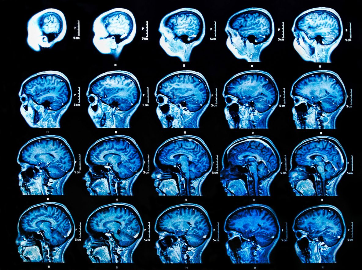 MRI scan of the human brain for Alzheimer's disease or dementia.