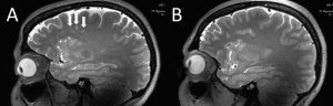 MRI study shows changes in the brain that occur in migraine.