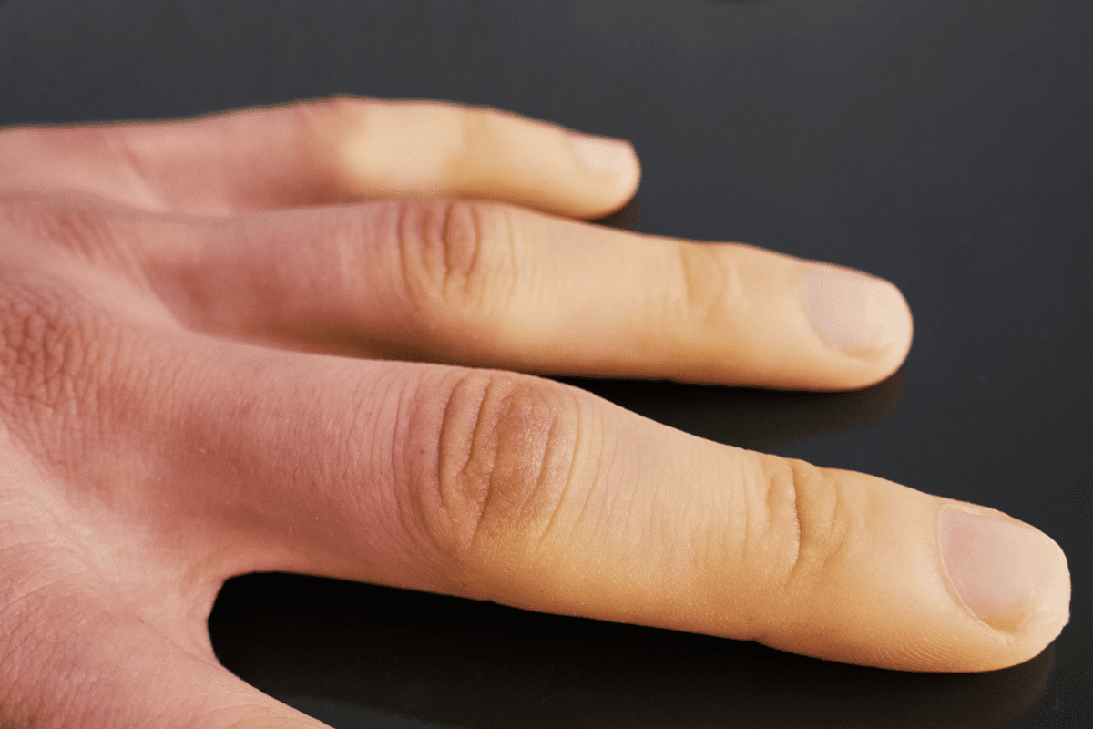 Raynaud's is a rare side effect from stimulants.