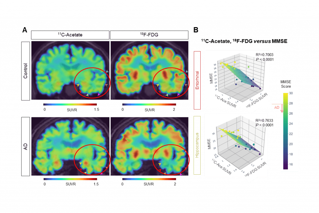 A. C-acetate and 18F-FDG PET imaging can visualize reactive astrogliosis and neuronal glucose hypometabolism in AD patients' brains. B. Multiple correlations between 11C-acetate SUVR, 18F-FDG SUVR in the entorhinal cortex and hippocampus, and MMSE scores. (Credit | IBS)