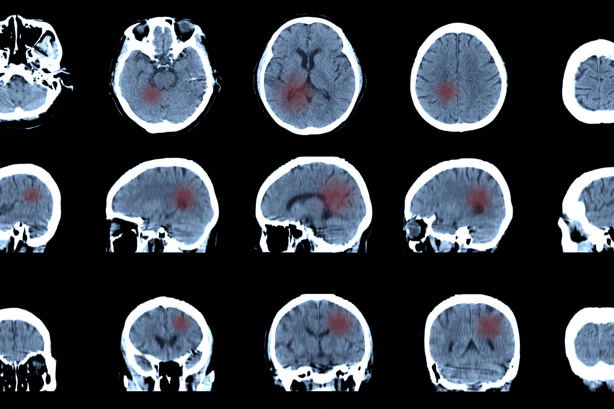A mystery cluster of pediatric brain abscesses has experts worried.