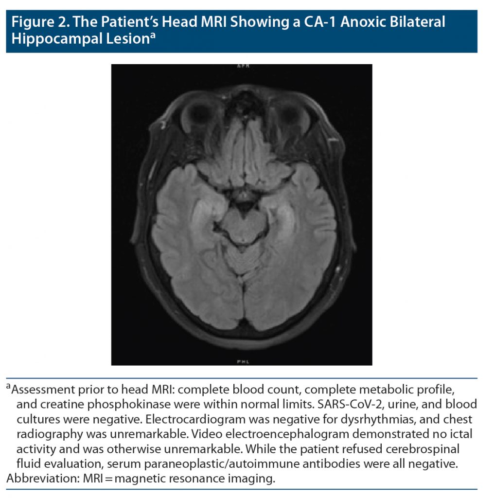 figure 2 of patient MRI showing hippocampal lesion