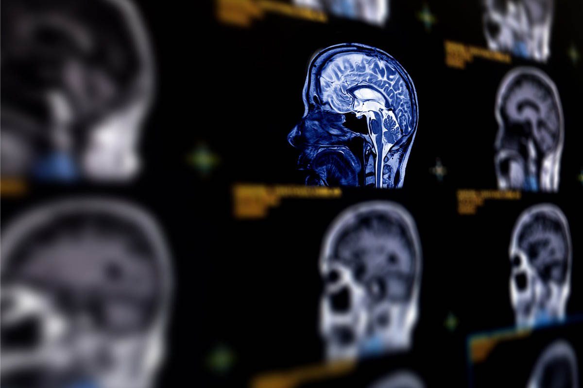 Dynamic Evolution of Catatonia in the Context of Cerebral Venous Sinus Thrombosis