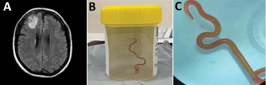 Rare parasitic infection by Ophidascaris robertsi worm, likely from contaminated food.