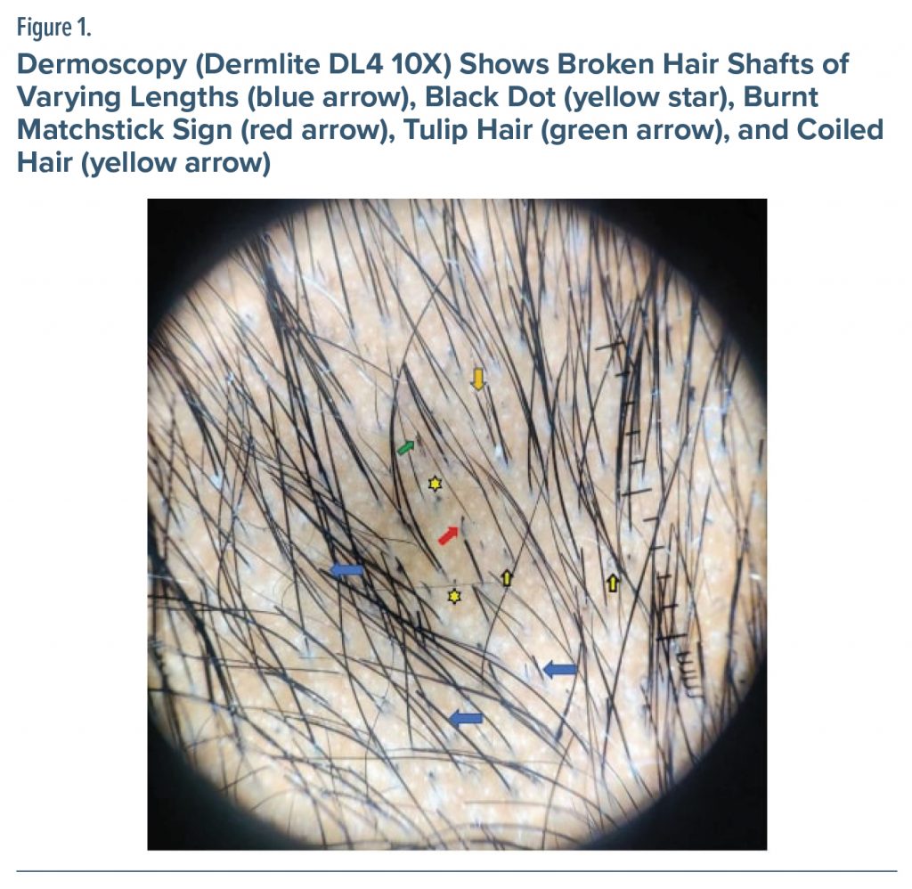 Figure-1 Dermoscopy Shows Broken Hair Shafts
