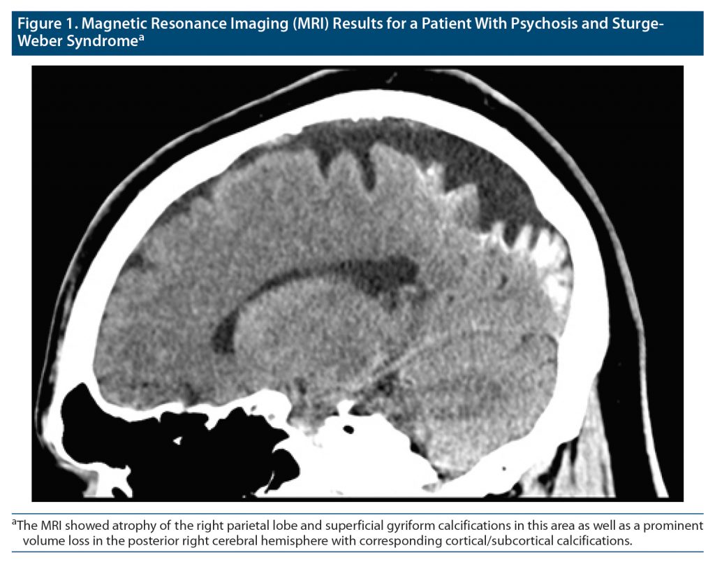 Figure-1 MRI Results for a Patient with Psychosis Sturge-Weber-Syndrome