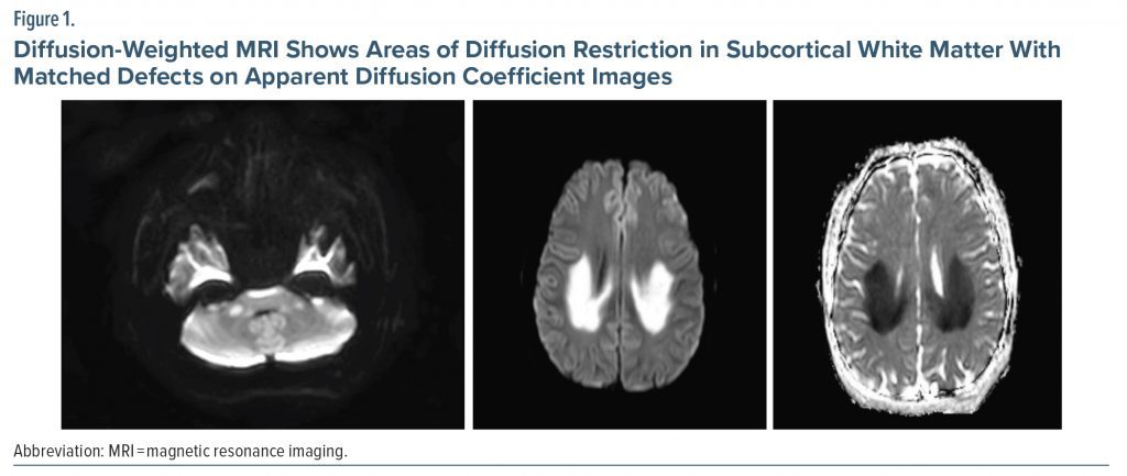 Figure-1 Diffusion Weighted MRI Areas of Diffusion Restriction