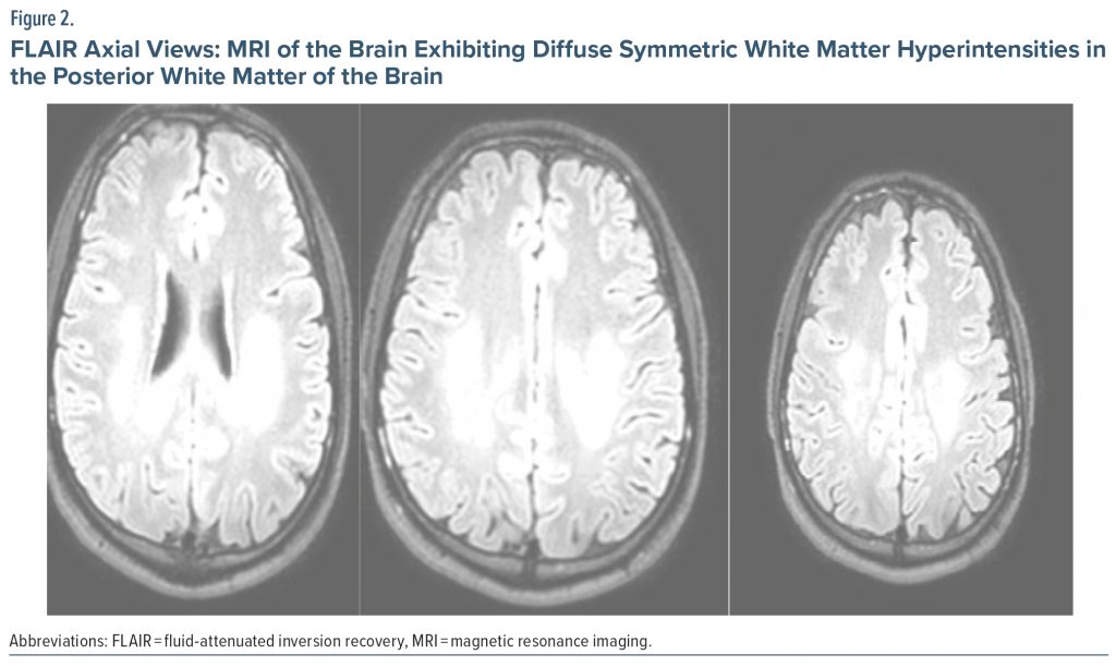 Figure-2 FLAIR Axial Views