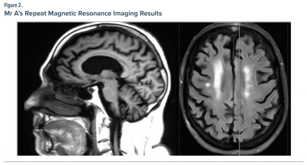 Figure-2 Mr A Repeat Magnetic Resonance Imaging Results