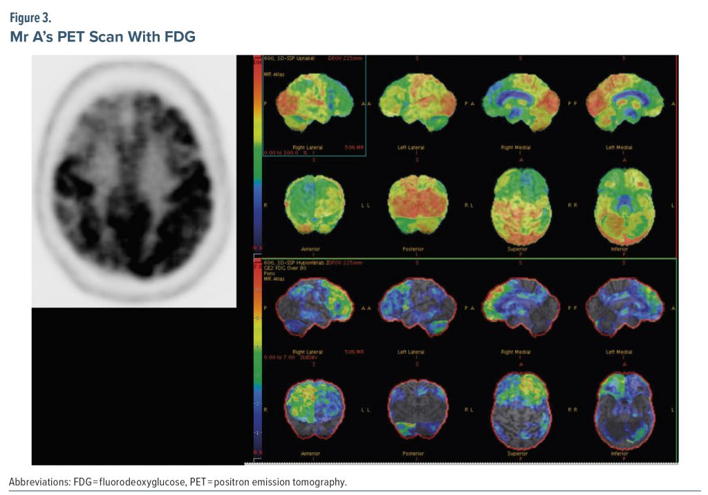 Figure-3 Mr A PET Scan With FDG
