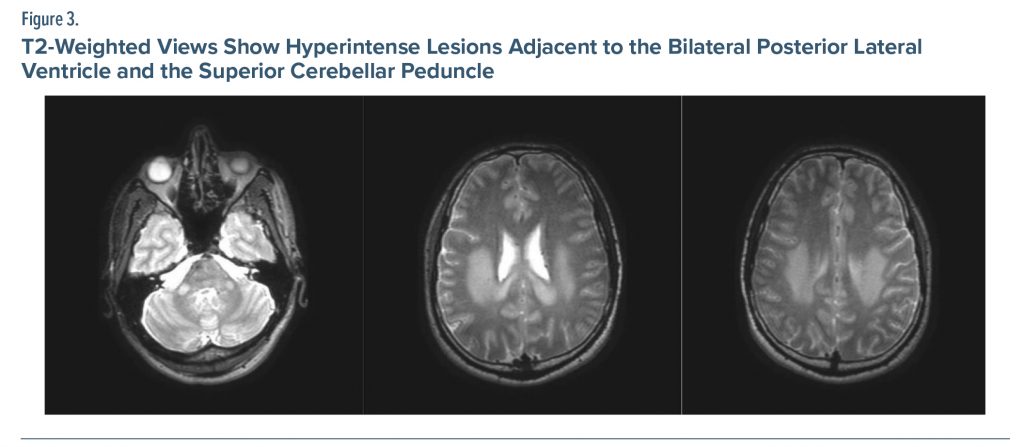 Figure-3 T2-Weighted Views Show Hyperintense Lesions