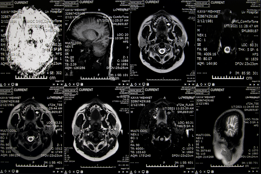 Brain network biomarkers in patients who have recovered from psychosis, offer valuable insights into predicting relapse and guiding personalized treatment strategies.