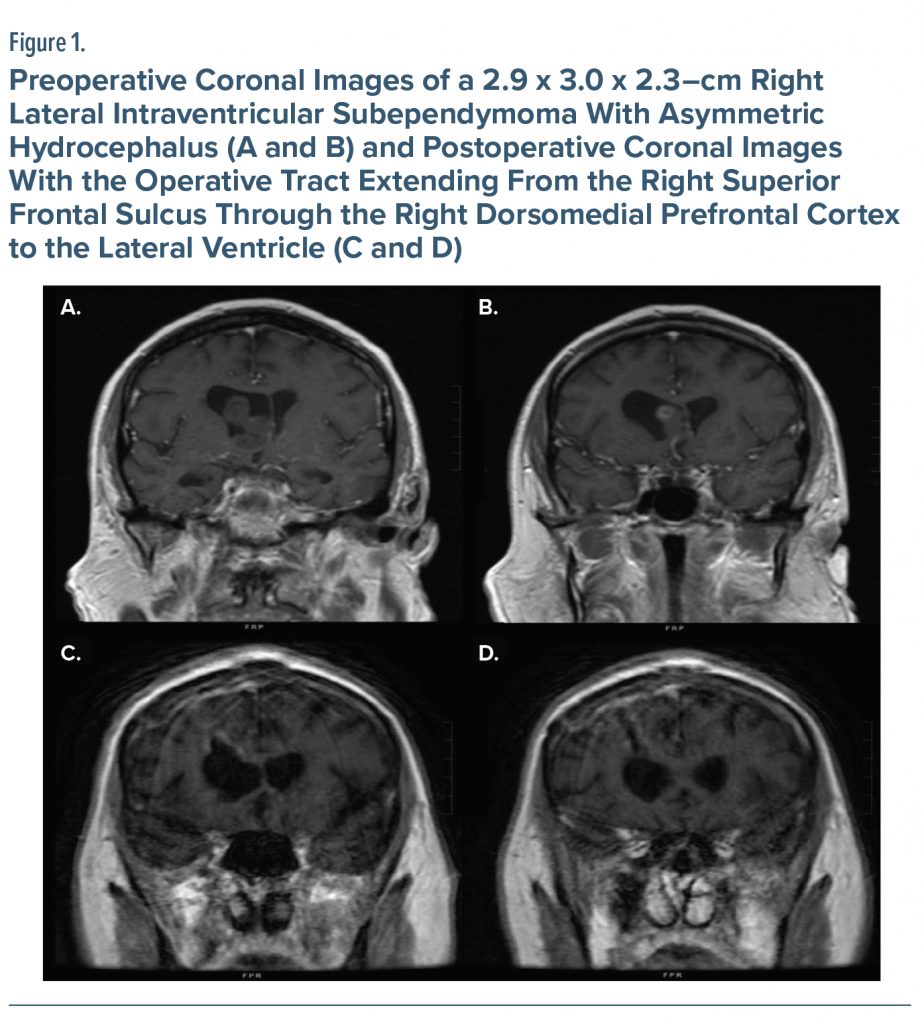 Figure-1 Preoperative Coronal Images