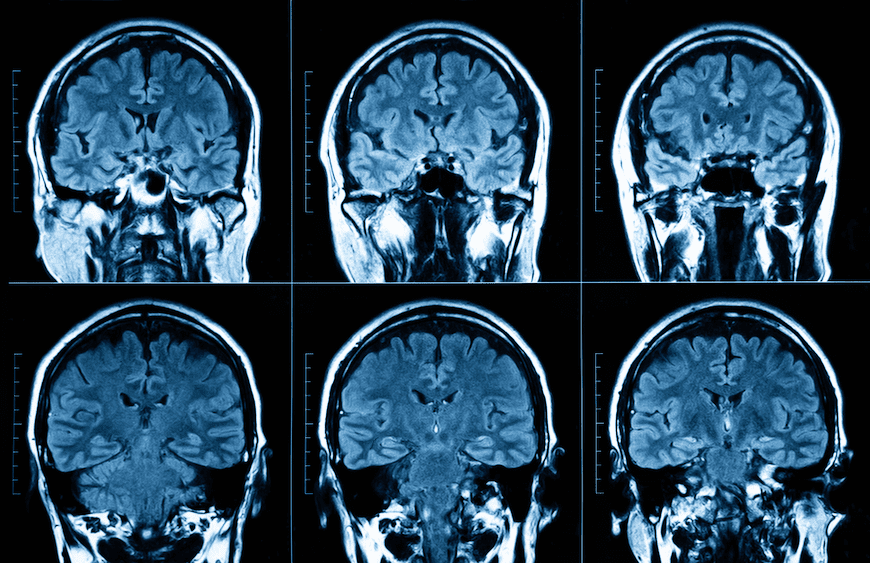 In findings that are as unsurprising as they are tragic, new research out of Brown University has found that Black Americans suffer strokes nearly 10 years earlier than their white counterparts.