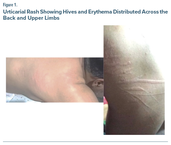 Clinical image showing a patient’s back and upper arm with erythematous, raised urticarial plaques under exam lighting.