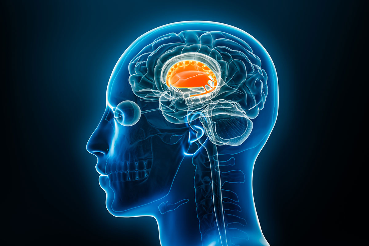 Basal Ganglia Stroke With Lower Motor Neuron Features