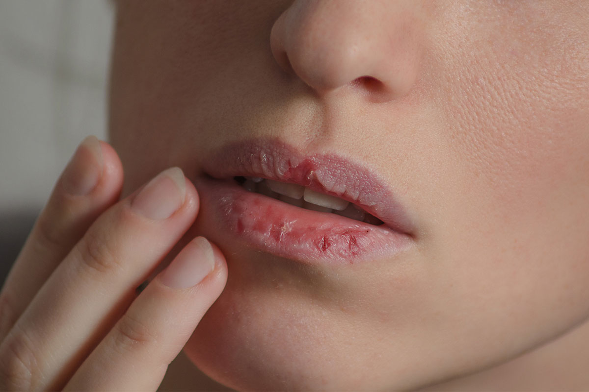 Skin Picking in Profound Intellectual Disability