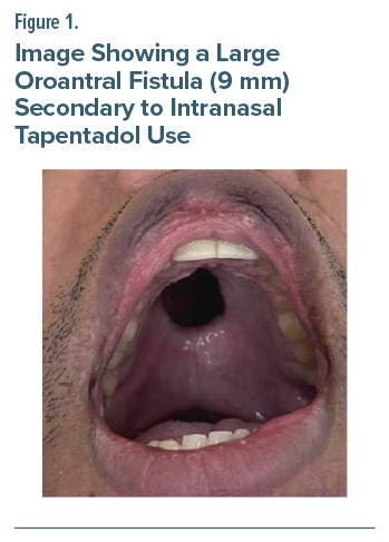 Figure shows open mouth with 9-mm oroantral fistula in upper palate, exposing nasal cavity; related to medication use.