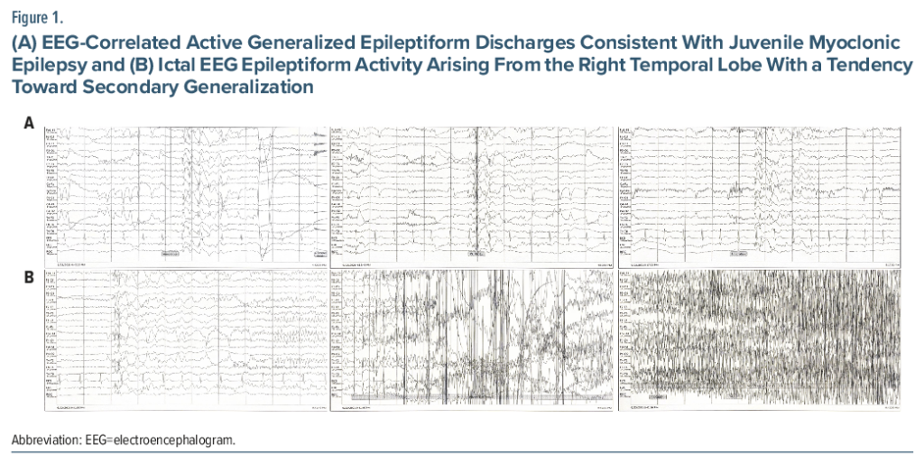 Coexistence of Mesial Temporal Sclerosis and Juvenile Myoclonic Epilepsy