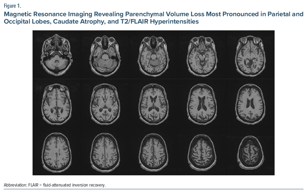 MRI brain scans show progressive parenchymal volume loss, notably in parietal and occipital lobes, with caudate atrophy.