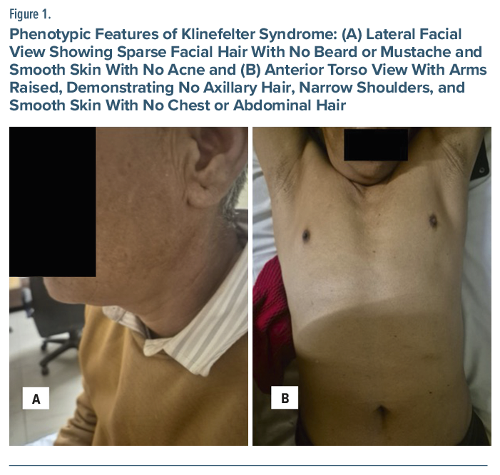 Phenotypic features of Klinefelter syndrome in lateral face and torso views