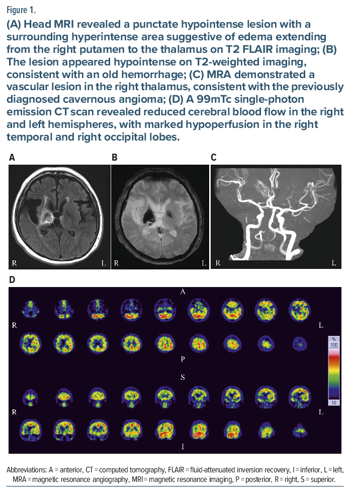 MRI and SPECT images of right thalamic lesion with associated edema and vascular features