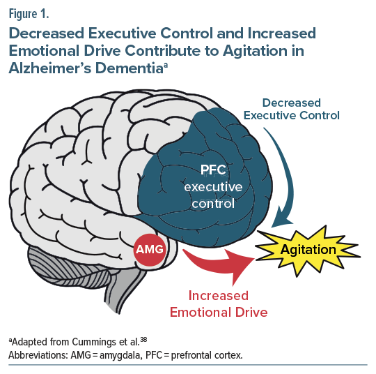 Brain diagram showing decreased executive control and emotional drive in Alzheimer's dementia