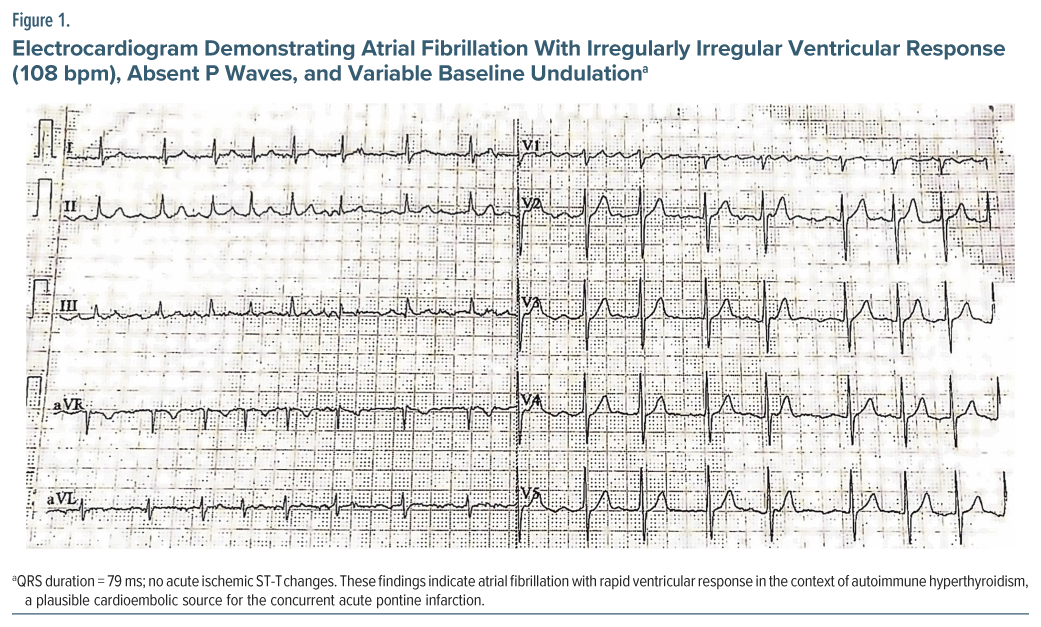 ECG showing atrial fibrillation with irregular ventricular response in autoimmune hyperthyroidism